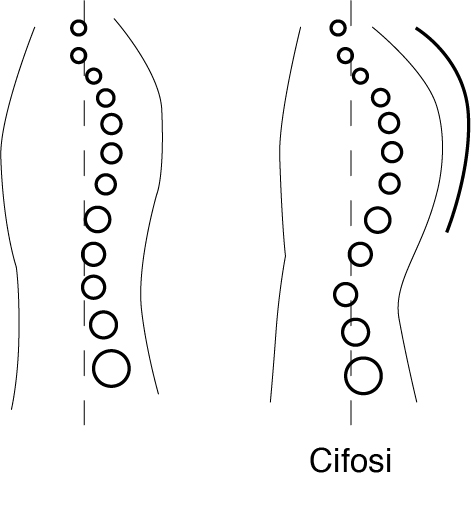 Cifosi