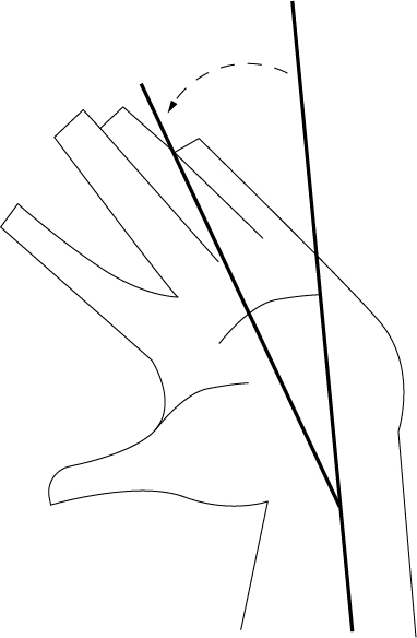 Deviazione radiale