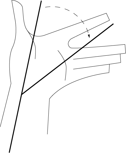Deviazione ulnare