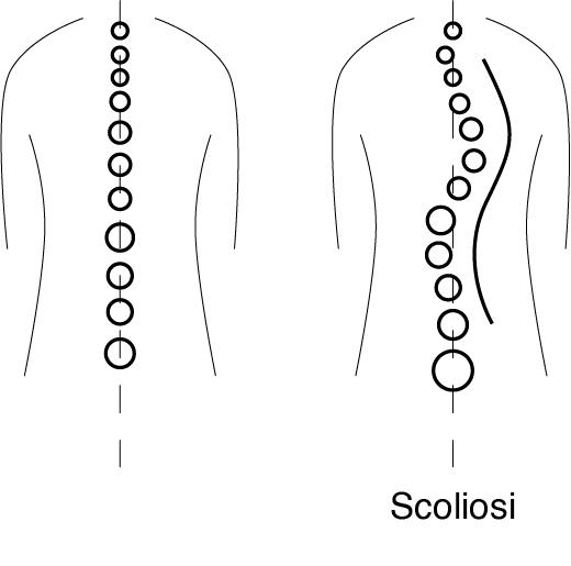 Scoliosi